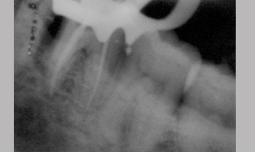 Cosmetic dentistry treatment in Anand
                        